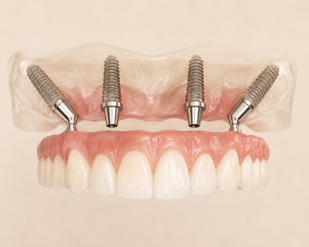 FULL ARCH REHABILITATIONS ALL-ON- X (4 & 6) Dr Felipe Marquez
