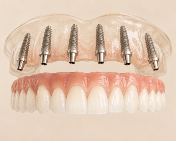 FULL ARCH REHABILITATIONS ALL-ON- X (4 & 6) Dr Felipe Marquez